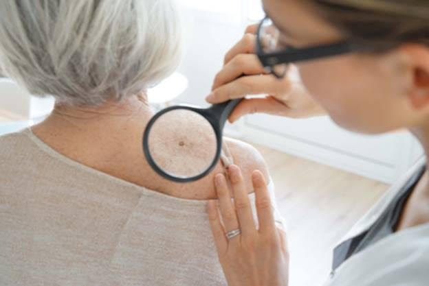 Dermatologist looking at a mole